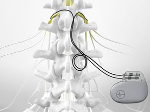 spinal cord stimulator vs dorsal column stimulator